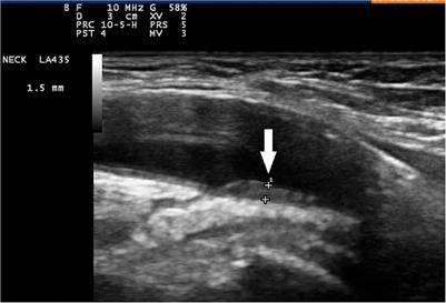 Intima-media thickness cut-off values depicting “halo sign” and potential confounder analysis for the best diagnosis of large vessel giant cell arteritis by ultrasonography